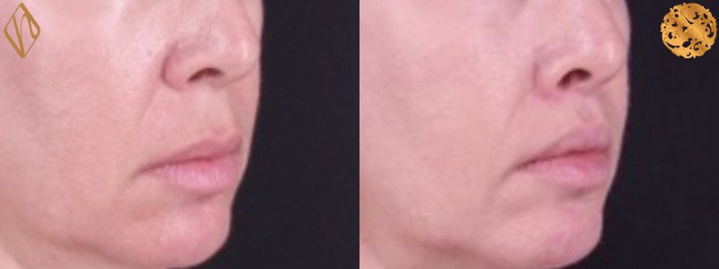 Upper Lip Lift 1 Combined Image