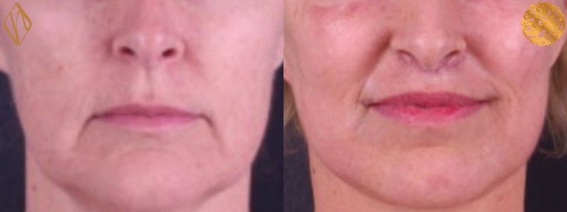 Upper Lip Lift 2 Combined Image