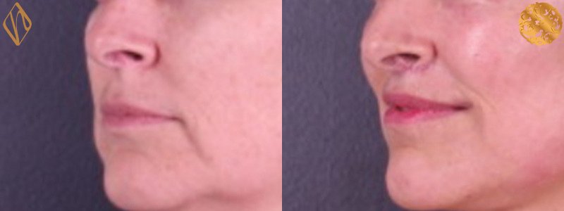 Upper Lip Lift 2 Combined Image