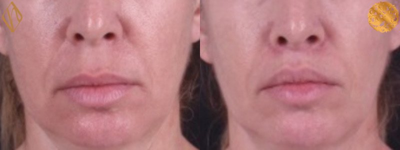 Upper Lip Lift 1 Combined Image