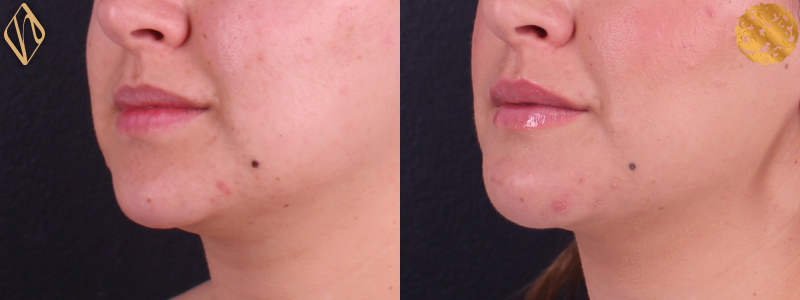 Chin Augmentation 1 Combined Image