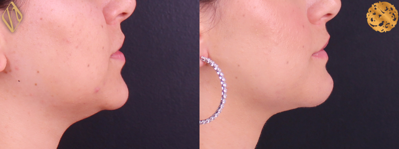 Chin Augmentation 1 Combined Image