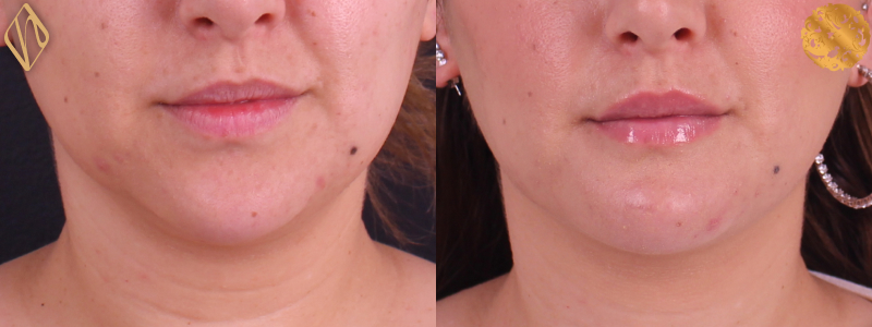 Chin Augmentation 1 Combined Image
