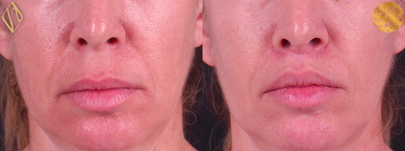 Upper Lip Lift #1 Combined Image