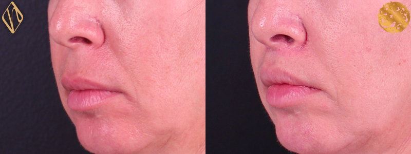 Upper Lip Lift #1 Combined Image