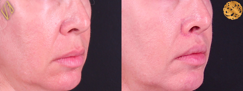 Upper Lip Lift #1 Combined Image