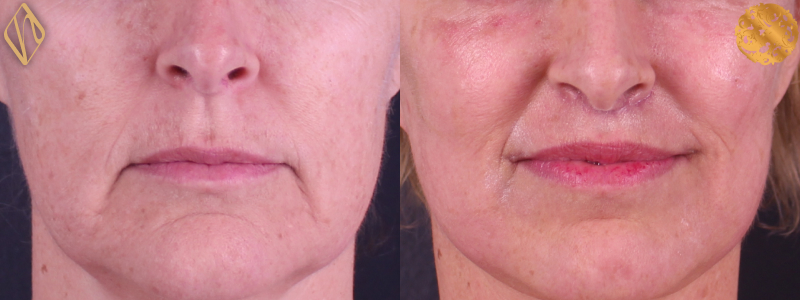 Upper Lip Lift #2 Combined Image