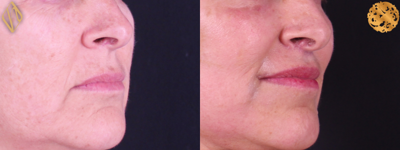 Upper Lip Lift #2 Combined Image