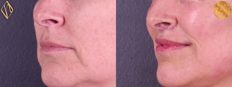Upper Lip Lift #2 Combined Image
